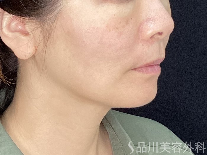 症例NO.71886のAFTER写真