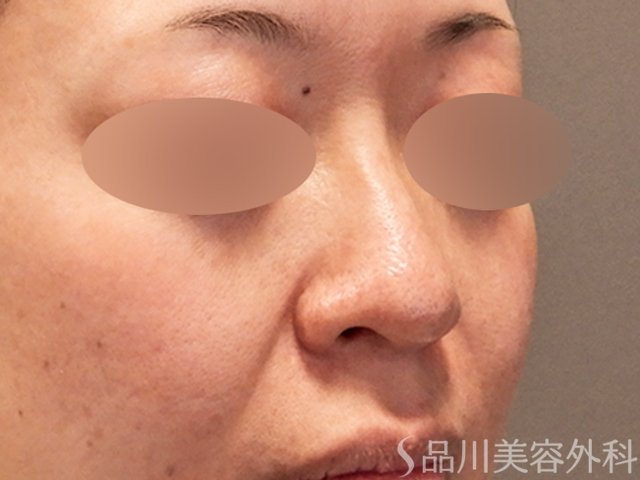 症例NO.69576のBEFORE写真