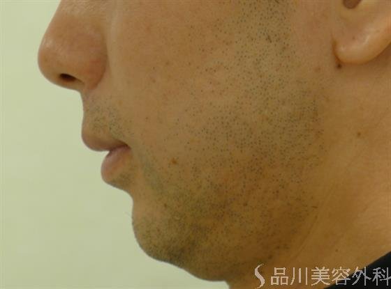 症例NO.34163のBEFORE写真