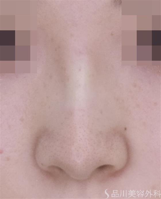 症例NO.49318のAFTER写真