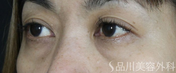 症例NO.68286のBEFORE写真