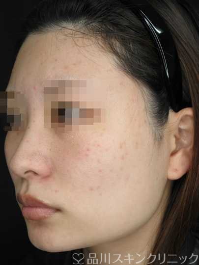 症例NO.70168のBEFORE写真