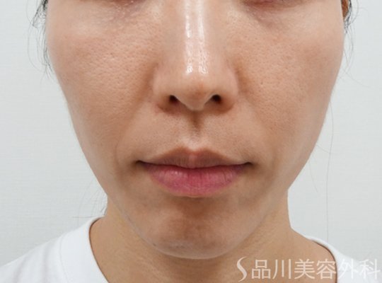 症例NO.72778のBEFORE写真