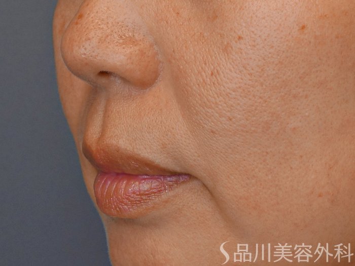 症例NO.71828のBEFORE写真