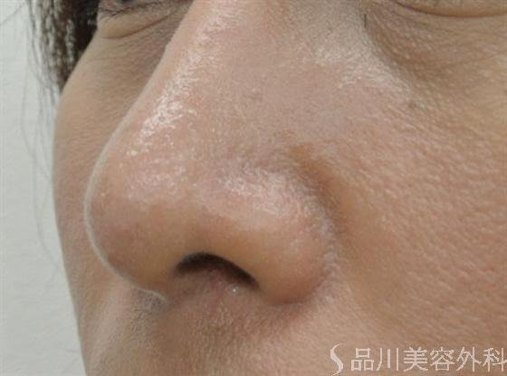 症例NO.15966のAFTER写真
