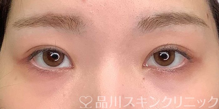 症例NO.69704のAFTER写真