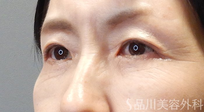 症例NO.70529のAFTER写真