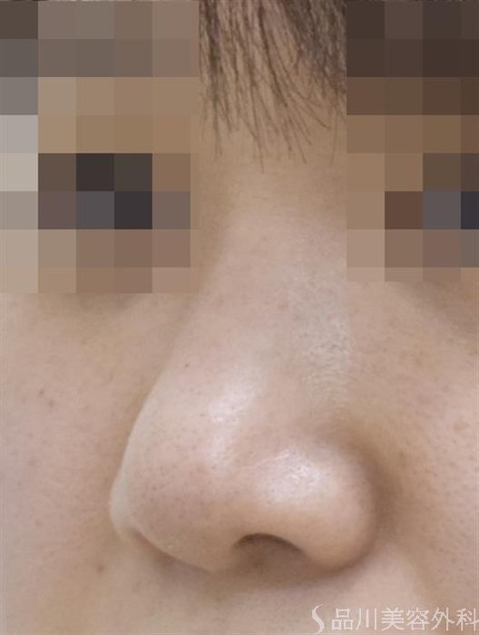 症例NO.50692のAFTER写真