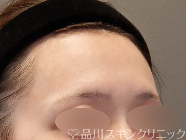 症例NO.75351のBEFORE写真