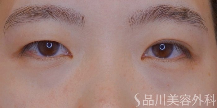 症例NO.74847のBEFORE写真