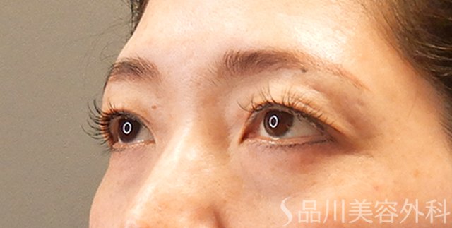 症例NO.70617のBEFORE写真