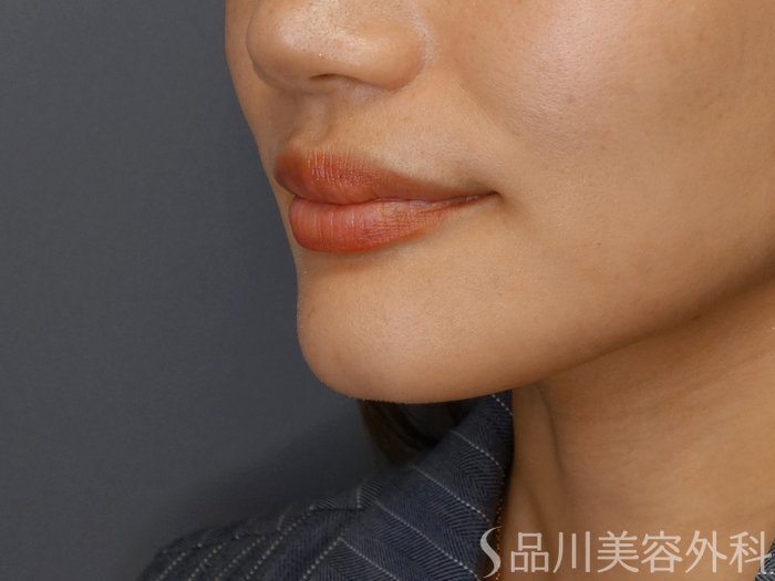症例NO.71489のBEFORE写真