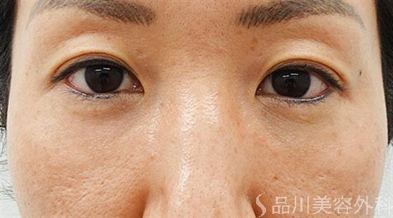 症例NO.44609のAFTER写真