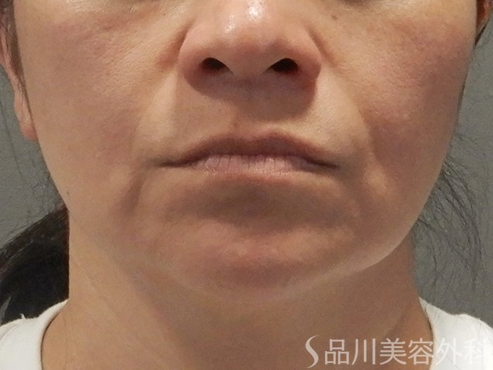 症例NO.71622のBEFORE写真