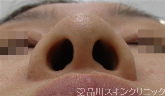 症例NO.36172のBEFORE写真