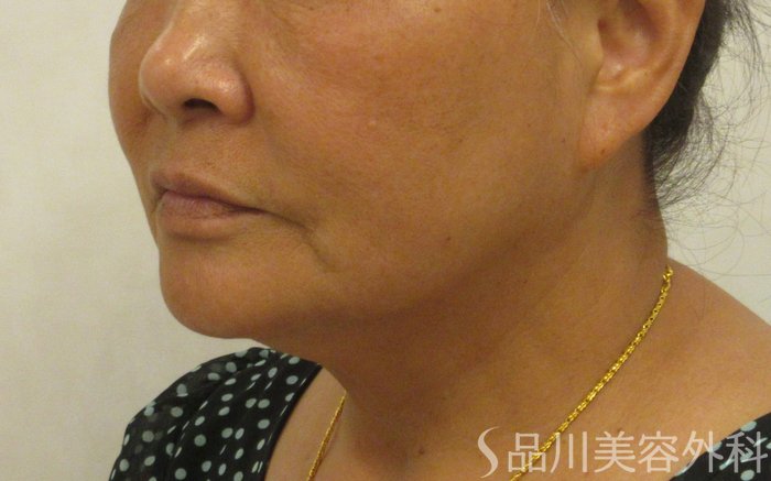 症例NO.72131のBEFORE写真