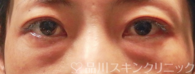 症例NO.66353のBEFORE写真