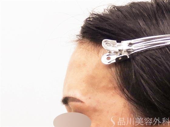 症例NO.57853のAFTER写真