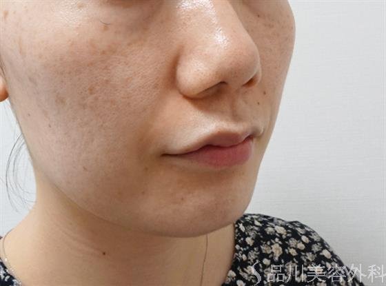 症例NO.51905のBEFORE写真