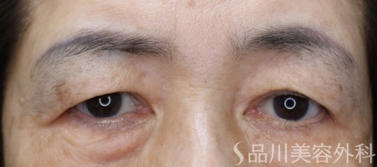 症例NO.74478のBEFORE写真