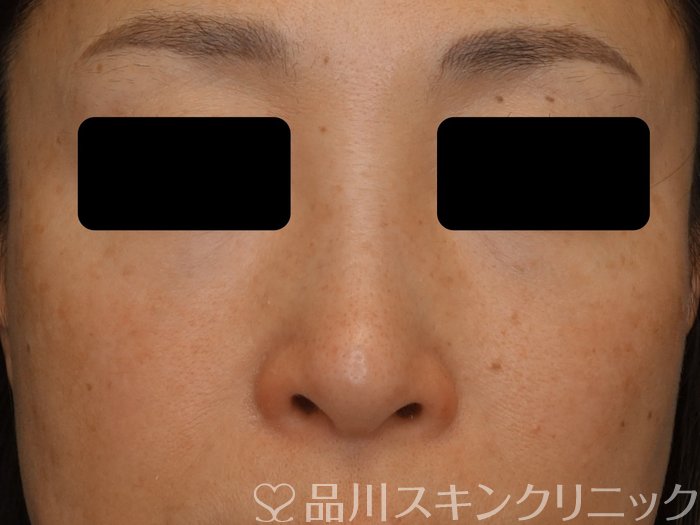 症例NO.74630のBEFORE写真