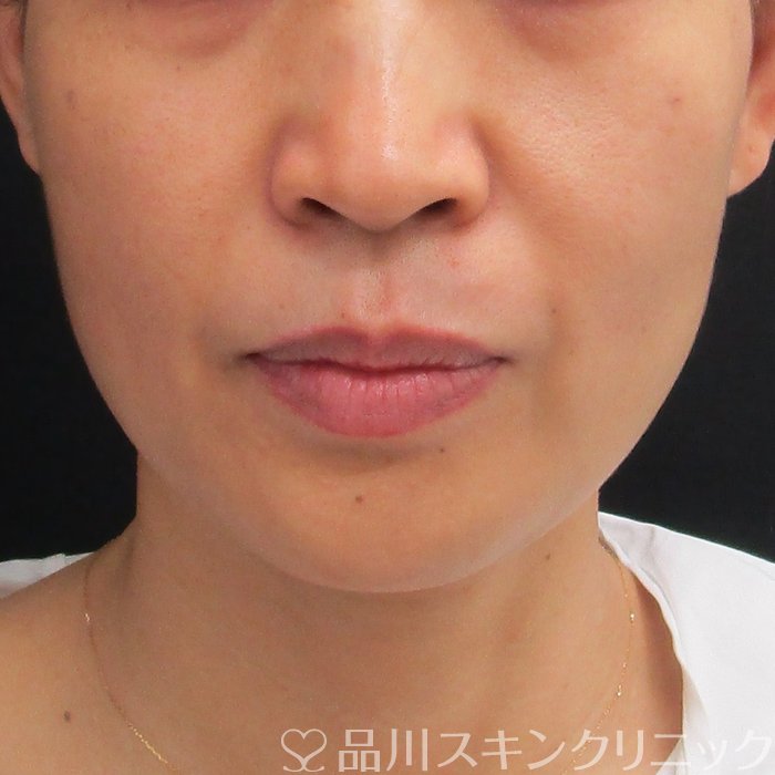 症例NO.74554のBEFORE写真