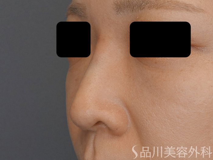 症例NO.71822のAFTER写真