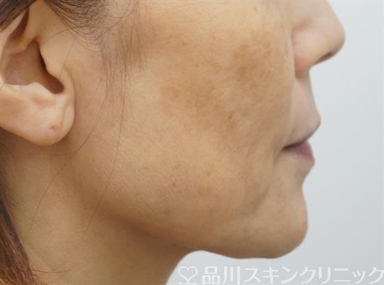症例NO.38039のBEFORE写真