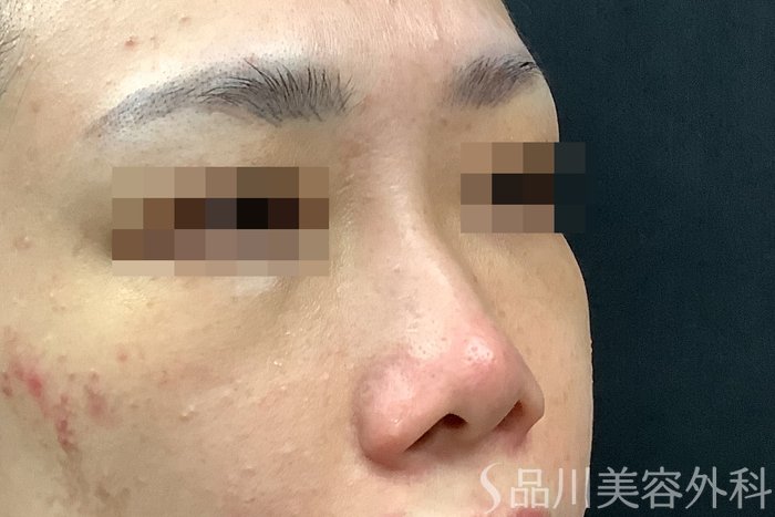 症例NO.71638のBEFORE写真