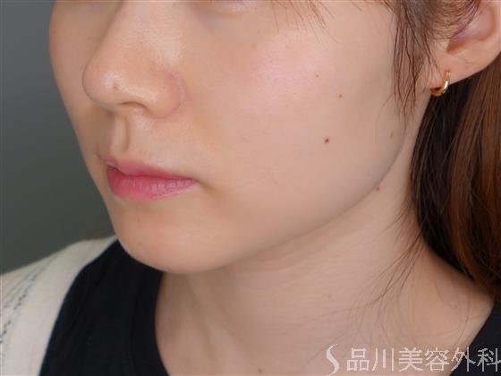 症例NO.52937のBEFORE写真