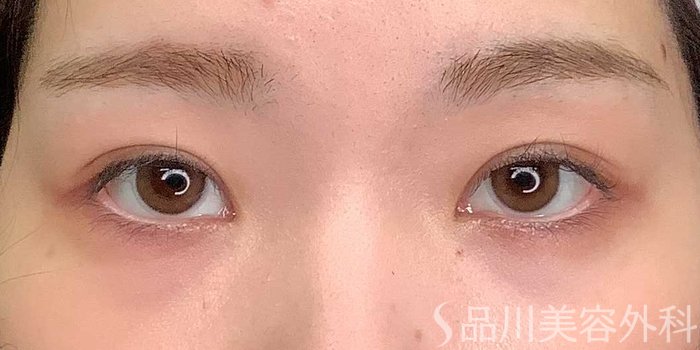 症例NO.69704のAFTER写真