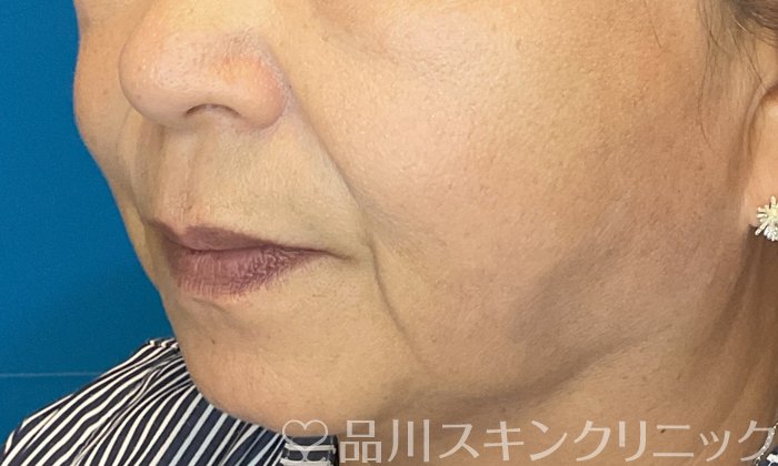 症例NO.74795のBEFORE写真