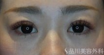 症例NO.75146のAFTER写真