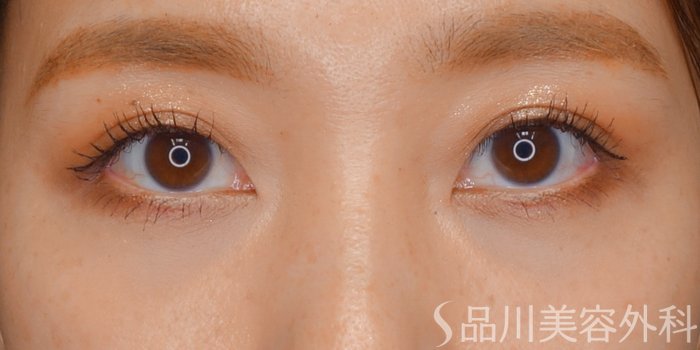 症例NO.73561のAFTER写真