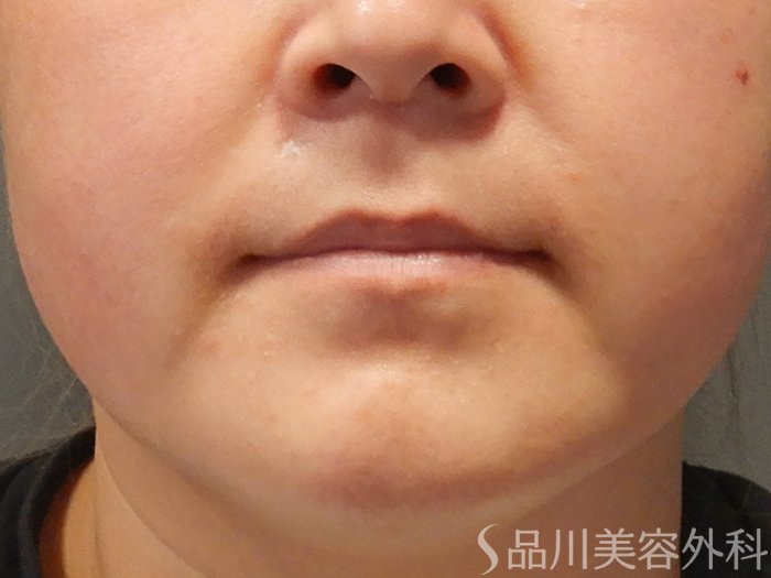症例NO.68026のBEFORE写真