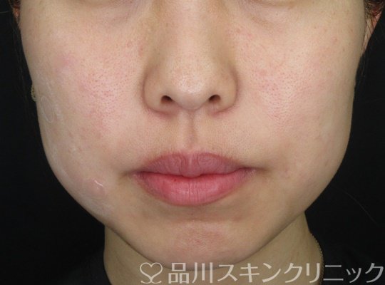 症例NO.70309のAFTER写真