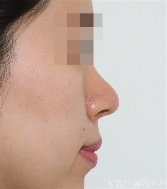 症例NO.47081のAFTER写真
