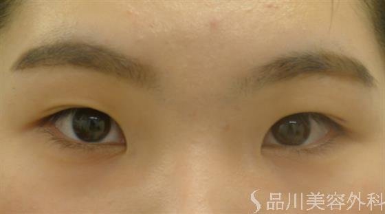 症例NO.56141のBEFORE写真