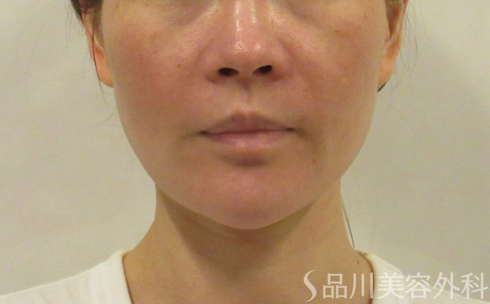 症例NO.72166のBEFORE写真