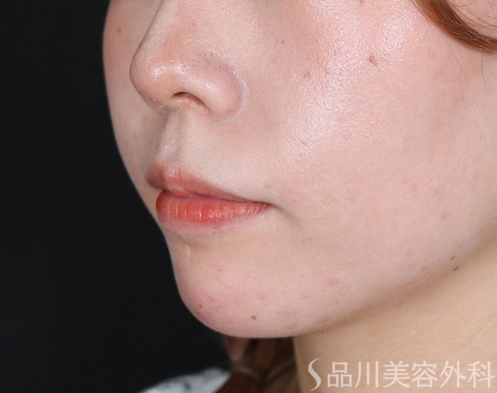 症例NO.71021のAFTER写真