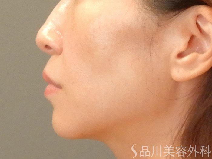 症例NO.66232のBEFORE写真