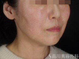 症例NO.73524のAFTER写真