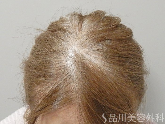 症例NO.69782のBEFORE写真