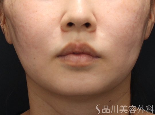 症例NO.75180のAFTER写真