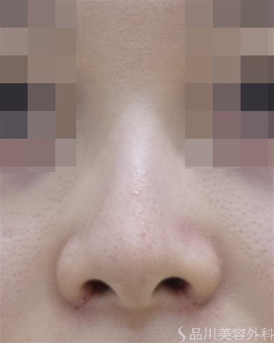 症例NO.47697のAFTER写真