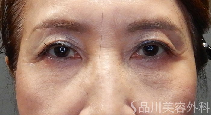症例NO.71187のAFTER写真