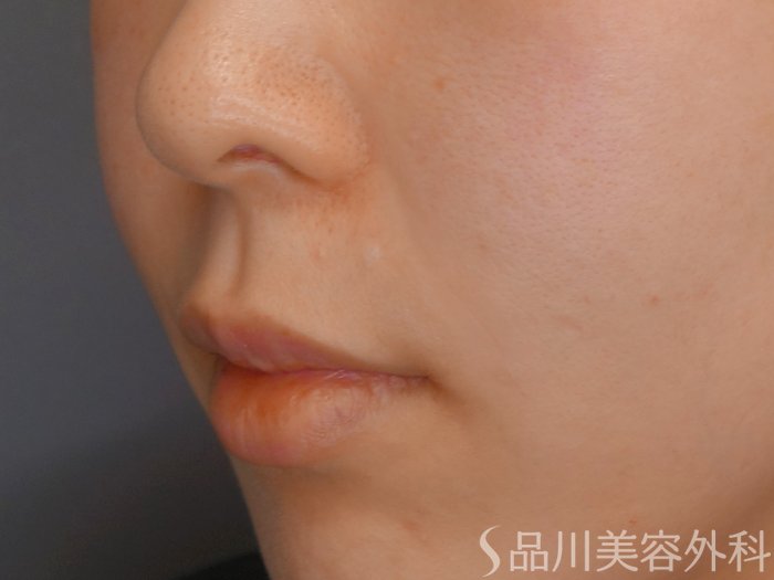 症例NO.69344のAFTER写真