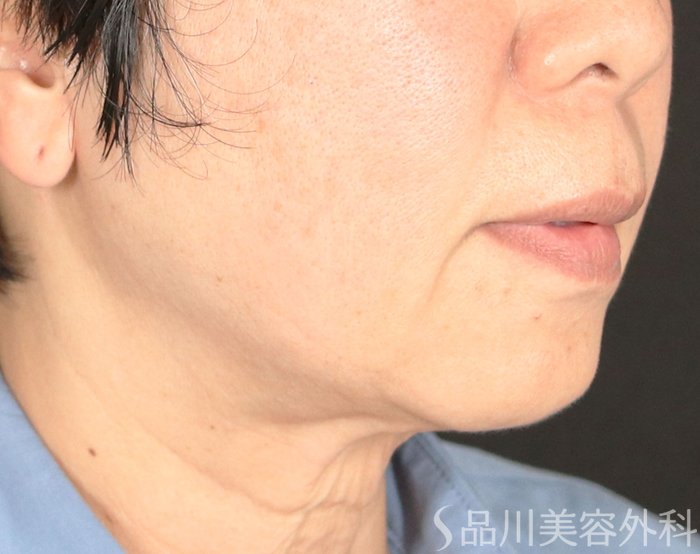 症例NO.73808のBEFORE写真
