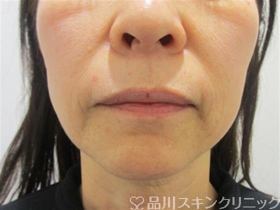 症例NO.42825のBEFORE写真
