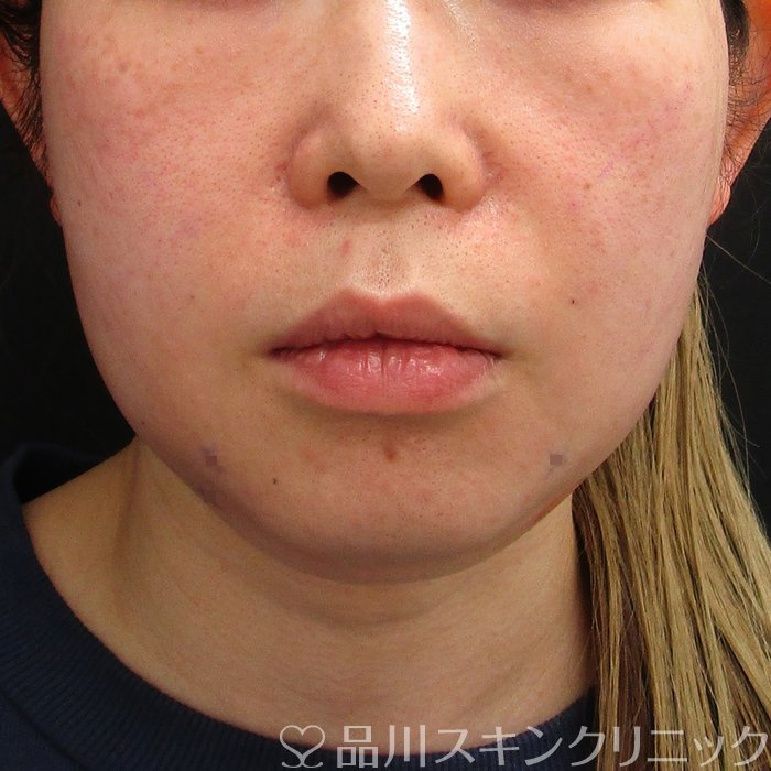 症例NO.73901のAFTER写真